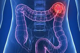 CANCER DE COLON